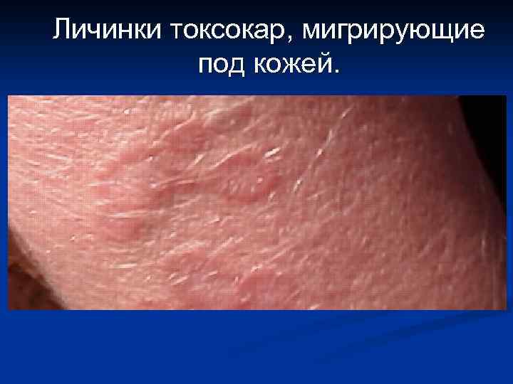 Личинки токсокар, мигрирующие под кожей. 