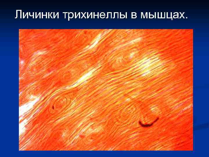 Личинки трихинеллы в мышцах. 