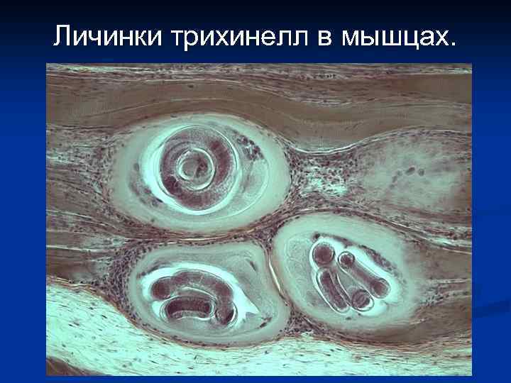 Личинки трихинелл в мышцах. 