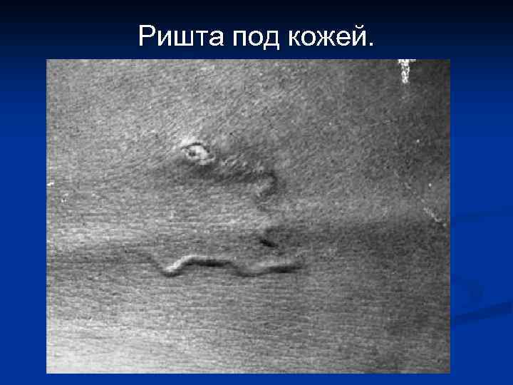 Ришта под кожей. 