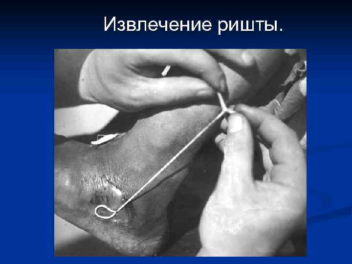 Извлечение ришты. 