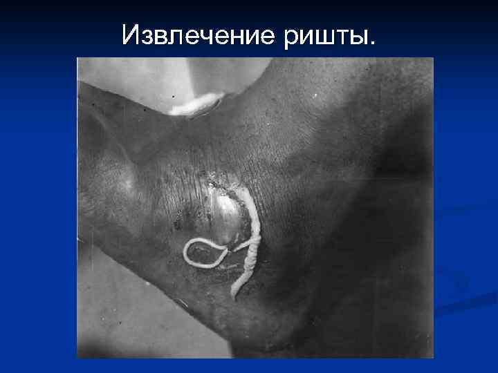 Извлечение ришты. 