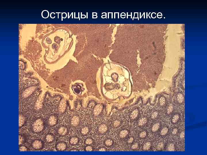 Острицы в аппендиксе. 