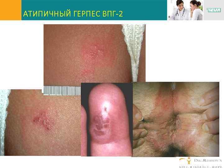 АТИПИЧНЫЙ ГЕРПЕС ВПГ-2 