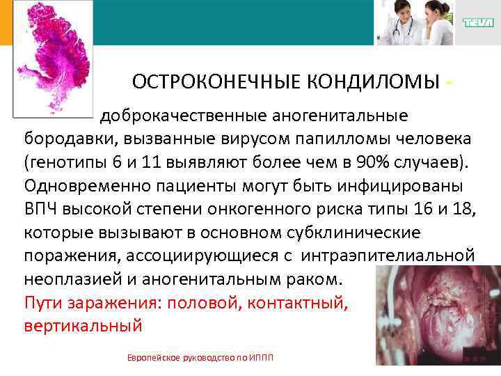ОСТРОКОНЕЧНЫЕ КОНДИЛОМЫ доброкачественные аногенитальные бородавки, вызванные вирусом папилломы человека (генотипы 6 и 11 выявляют