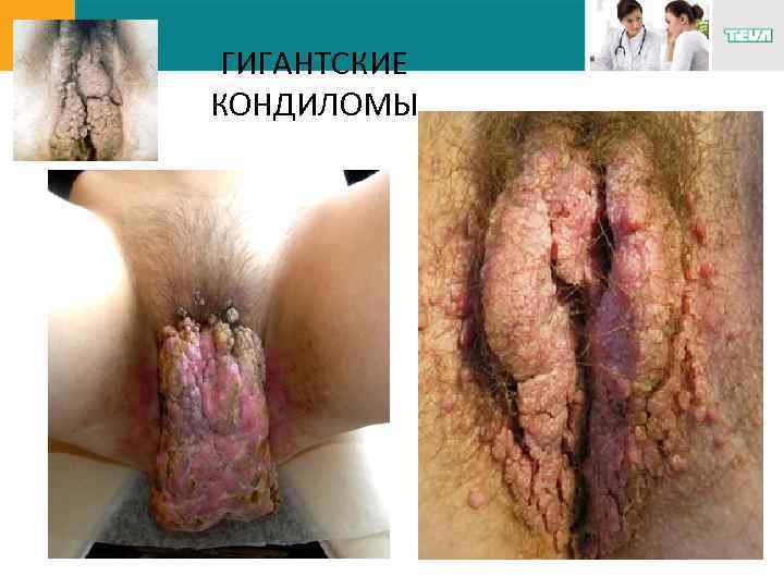 ГИГАНТСКИЕ КОНДИЛОМЫ 