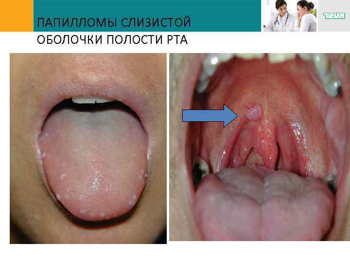 ПАПИЛЛОМЫ СЛИЗИСТОЙ ОБОЛОЧКИ ПОЛОСТИ РТА 
