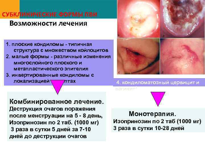 CУБКЛИНИЧЕСКИЕ ФОРМЫ ПВИ Возможности лечения 1. плоские кондиломы - типичная структура с множеством койлоцитов