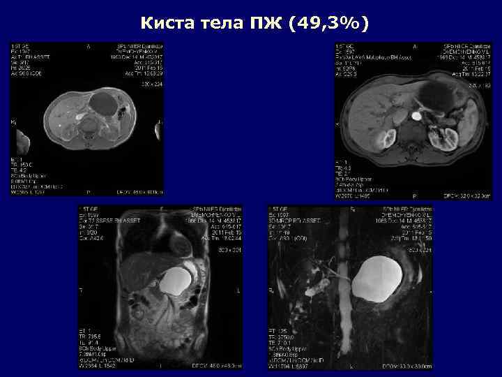 Киста тела ПЖ (49, 3%) 