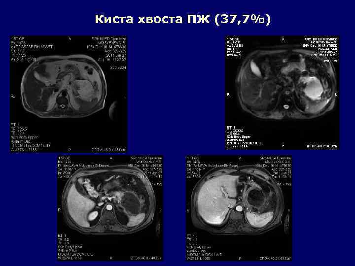 Киста хвоста ПЖ (37, 7%) 