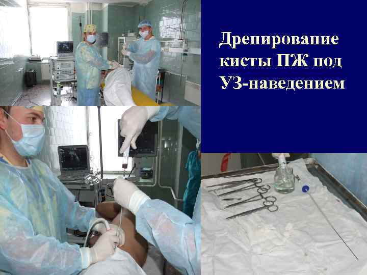 Дренирование кисты ПЖ под УЗ-наведением 