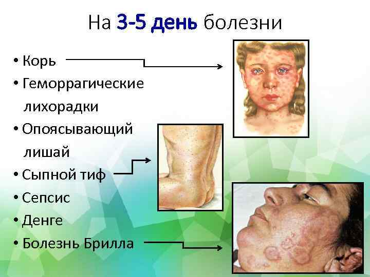 На 3 -5 день болезни • Корь • Геморрагические лихорадки • Опоясывающий лишай •