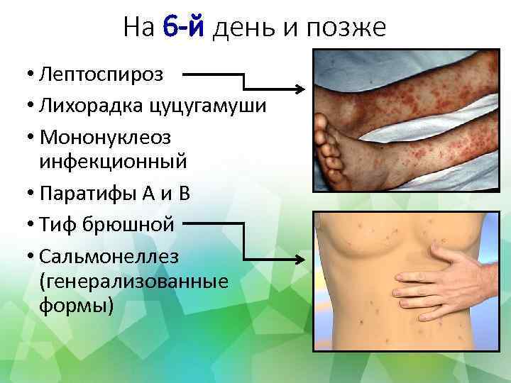На 6 -й день и позже • Лептоспироз • Лихорадка цуцугамуши • Мононуклеоз инфекционный
