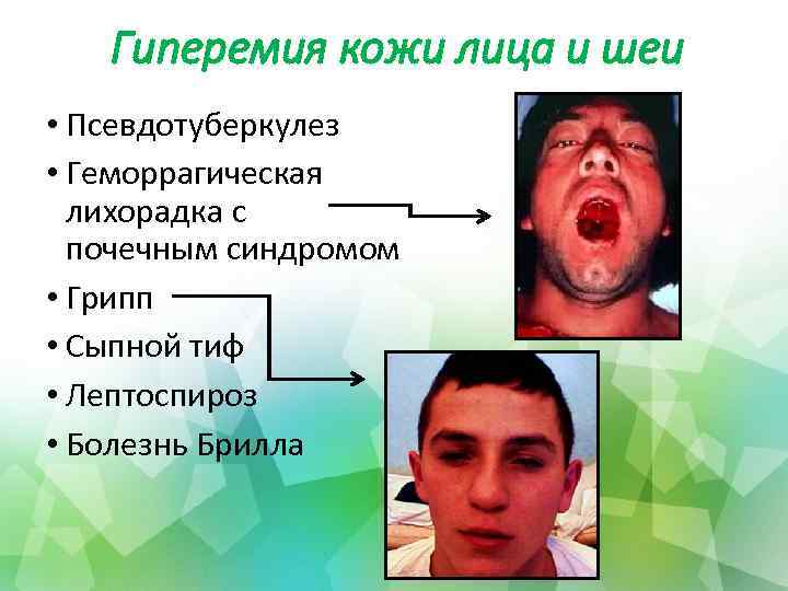 Гиперемия кожи лица и шеи • Псевдотуберкулез • Геморрагическая лихорадка с почечным синдромом •