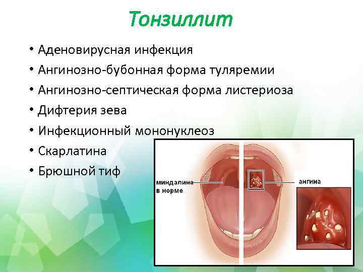 Тонзиллит • Аденовирусная инфекция • Ангинозно-бубонная форма туляремии • Ангинозно-септическая форма листериоза • Дифтерия