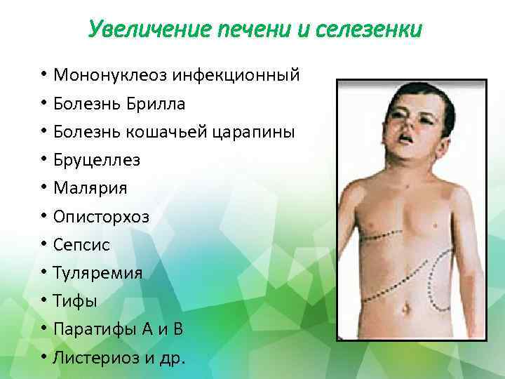 Увеличение печени и селезенки • Мононуклеоз инфекционный • Болезнь Брилла • Болезнь кошачьей царапины