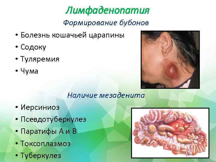 Лимфаденопатия Формирование бубонов • Болезнь кошачьей царапины • Содоку • Туляремия • Чума Наличие