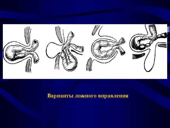 Вправление ущемленной грыжи. Ложное ущемление грыжа Брока. Ложное вправление ущемленной грыжи. Вправление грыжи операция. Грыжа Брока мнимое ущемление.