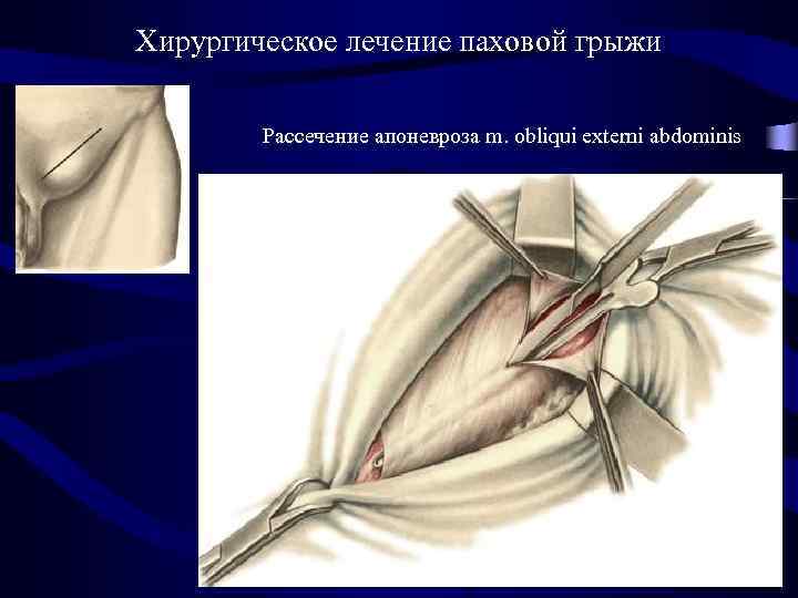 Хирургическое лечение паховой грыжи Рассечение апоневроза m. obliqui externi abdominis 