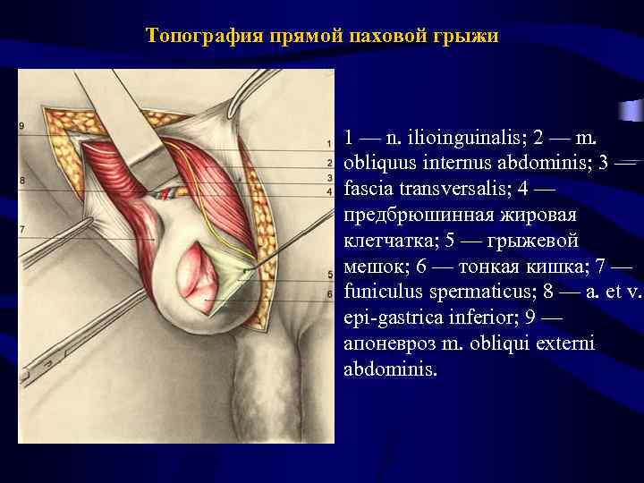 Топография прямой паховой грыжи 1 — n. ilioinguinalis; 2 — m. obliquus internus abdominis;