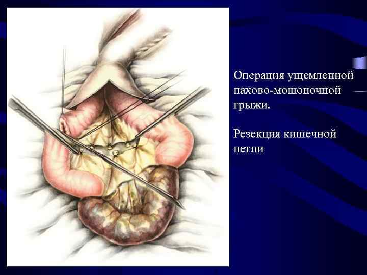 Операция ущемленной пахово-мошоночной грыжи. Резекция кишечной петли 