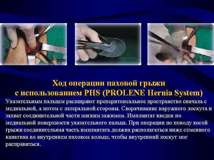Ход операции паховой грыжи с использованием PHS (PROLENE Hernia System) Указательным пальцем расширяют преперитонеальное
