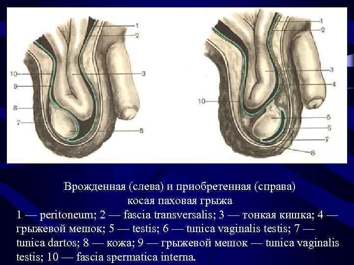 Врожденная (слева) и приобретенная (справа) косая паховая грыжа 1 — peritoneum; 2 — fascia