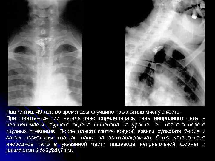 Пациентка, 49 лет, во время еды случайно проглотила мясную кость. При рентгеноскопии неотчетливо определялась