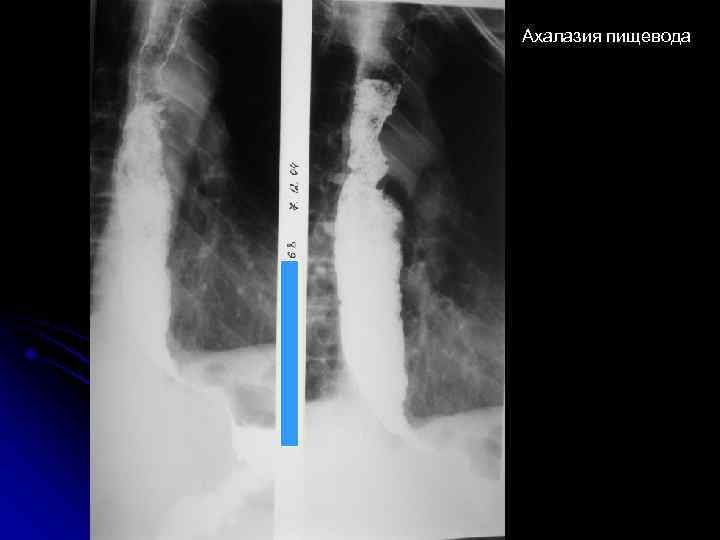 Ахалазия пищевода 