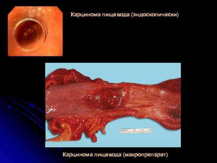 Карцинома пищевода (эндоскопически) Карцинома пищевода (макропрепарат) 