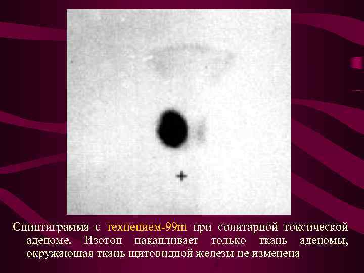 Сцинтиграмма с технецием-99 m при солитарной токсической аденоме. Изотоп накапливает только ткань аденомы, окружающая