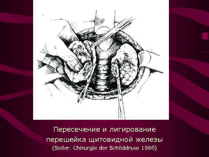 Пересечение и лигирование перешейка щитовидной железы (Seiler. Chirurgie der Schilddrьse 1986) 