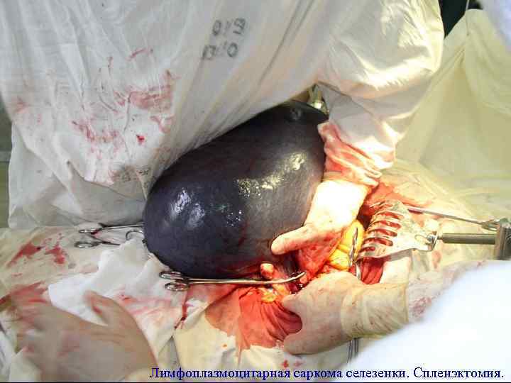Лимфоплазмоцитарная саркома селезенки. Спленэктомия. 