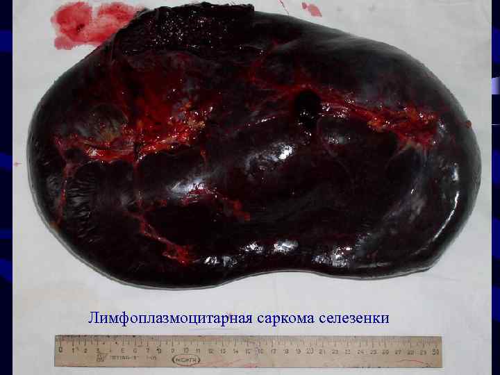 Лимфоплазмоцитарная саркома селезенки 