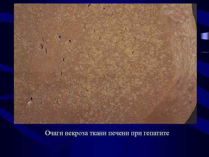 Очаги некроза ткани печени при гепатите 