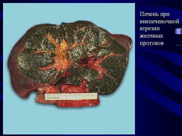 Печень при внепеченочной атрезии желчных протоков 