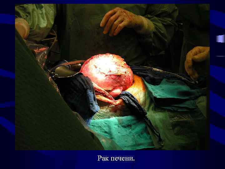 Рак печени. 