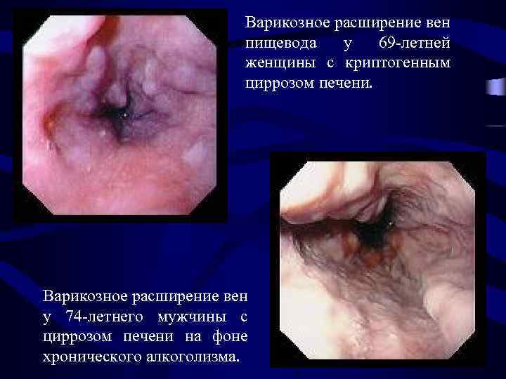 Варикозное расширение вен пищевода у 69 -летней женщины с криптогенным циррозом печени. Варикозное расширение