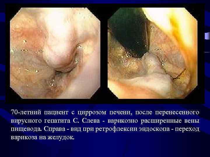 70 -летний пациент с циррозом печени, после перенесенного вирусного гепатита С. Слева - варикозно