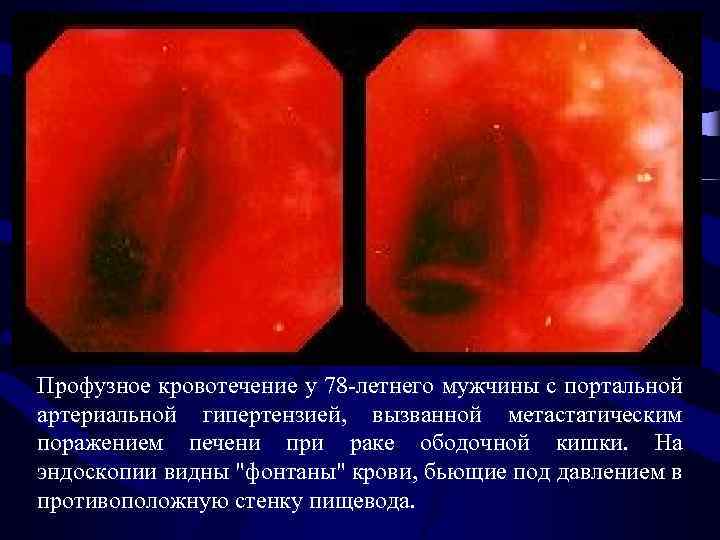 Профузное кровотечение у 78 -летнего мужчины с портальной артериальной гипертензией, вызванной метастатическим поражением печени