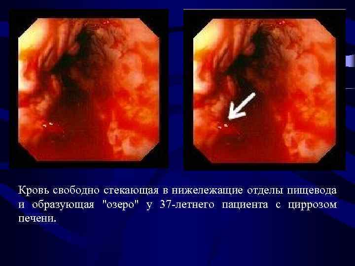 Кровь свободно стекающая в нижележащие отделы пищевода и образующая "озеро" у 37 -летнего пациента