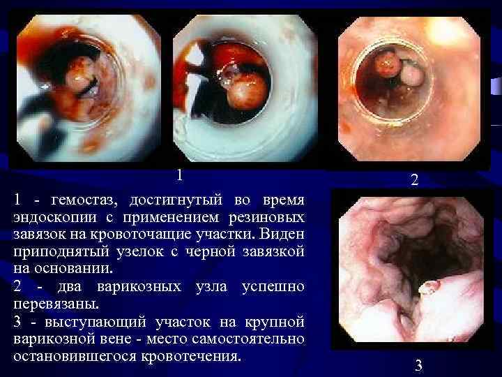 1 1 - гемостаз, достигнутый во время эндоскопии с применением резиновых завязок на кровоточащие