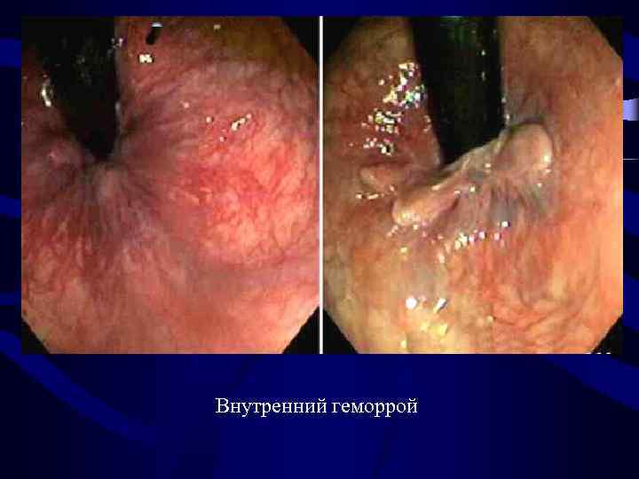 Внутренний геморрой 