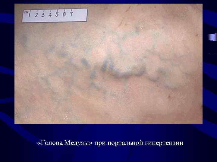  «Голова Медузы» при портальной гипертензии 