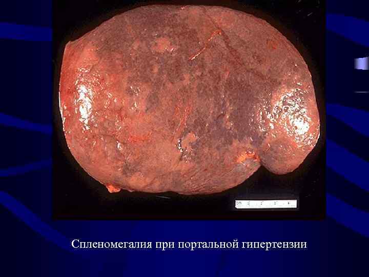 Спленомегалия при портальной гипертензии 
