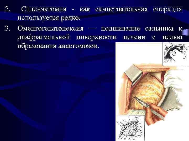 2. Спленэктомия - как самостоятельная операция используется редко. 3. Оментогепатопексия — подшивание сальника к