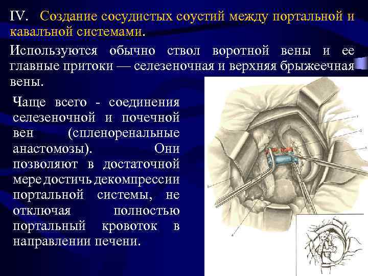 IV. Создание сосудистых соустий между портальной и кавалъной системами. Используются обычно ствол воротной вены