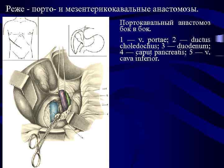 Реже - порто- и мезентерикокавальные анастомозы. Портокавальный анастомоз бок в бок. 1 — v.