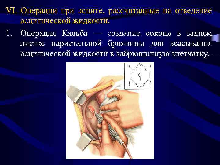 VI. Операции при асците, рассчитанные на отведение асцитической жидкости. 1. Операция Кальба — создание