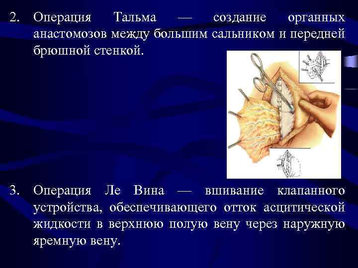 2. Операция Тальма — создание органных анастомозов между большим сальником и передней брюшной стенкой.